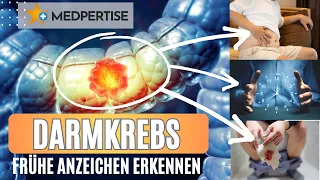 Ihr Stuhl verrät mehr, als Sie denken: Frühe Anzeichen für Darmkrebs, die jeden betreffen können.