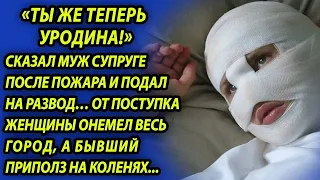 Увидев лицо жены после пожара, супруг бросил ее, а встретив через год, кусал локти