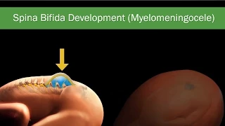 Fetal Spina Bifida: Comprehensive Guide on Diagnosis, Treatment & Surgery