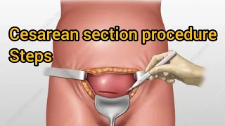 cesarean / caesarean section / c-section steps explained