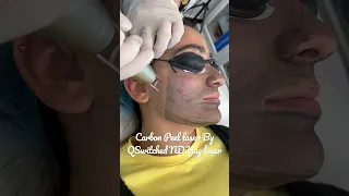 Laser Carbon peel for Open Pores & Acne #olimpiacarmen #hollywood #laserexperts #skincaretips