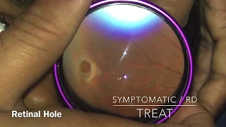 Retinal Break ( Tear & Hole) ||  when to treat a break / Barrage laser for retinal break, tear, hole