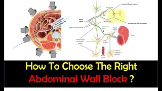 Abdominal Wall Blocks for Surgery - How To Choose the Right Technique?