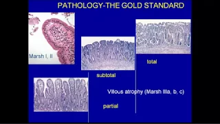 Celiac Disease and Non Celiac Gluten (Wheat) Sensitivity