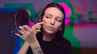 Розлад колупання шкіри | Дерматиломанія | Skin Picking Disorder