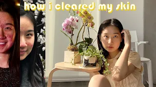 HOW I CLEARED MY ACNE: lifestyle & food for skin | glow up journal 11