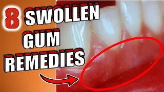 8 Home Remedies To Get Rid of Swollen Gums