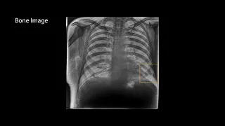 Reveal Clinical Case 3: Discover fractures in a PA chest X ray