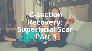 How I Healed After My C-sections: Scar Work
