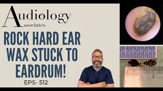 ROCK HARD EAR WAX STUCK TO EARDRUM - EP512