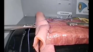 Laparoscopic Pancreaticojejunostomy Blumgart (Laparoscopic Suturing)