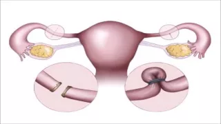 Cosmetic Gynecology: An Overview at NJ Ob Gyn Society 06.04.2016