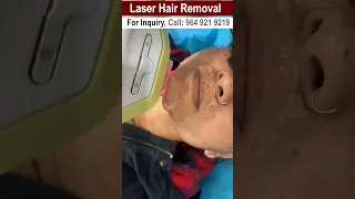 The Future of Laser Face Hair Removal, According to an Expert | Viral #shorts