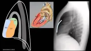 Lateral CXR  Part 1 Anatomy - "EM in 5"