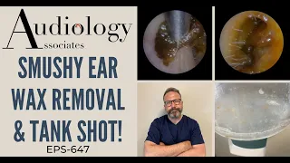 "SMUSHY" EAR WAX REMOVAL - EP647