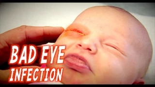 BAD EYE INFECTION (Infant) | Dr. Paul