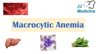 Macrocytic Anemia | Megaloblastic vs Non-Megaloblastic | Approach & Causes