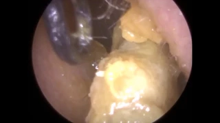 "800 Mile" Ear Wax Removal from both Ears by Mr Neel Raithatha - Ep 306