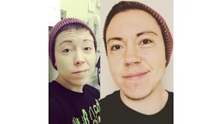 FTM One year on Testosterone: My Story