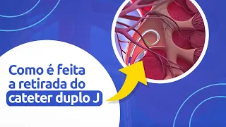 Como é feita a retirada do cateter duplo J