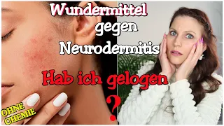 NEURODERMITIS | Mein Wundermittel! Hab ich gelogen. . .