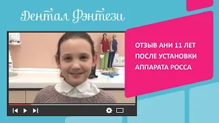 😊 Отзыв Ани 11 лет после установки аппарата Росса