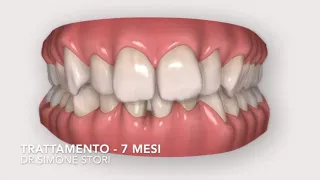 Invisalign Prima e Dopo - Caso di Denti Molto Affollati - Bologna