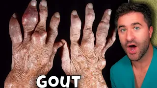 The BIGGEST Reason People Get Gout