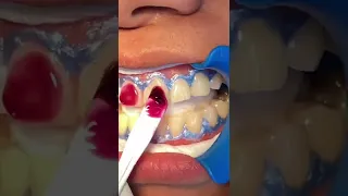 Blanqueamiento dental en el consultorio