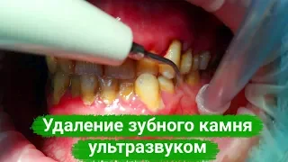 Удаление зубного камня ультразвуком (скалер) / Dental plaque