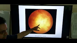 Sarcoidosis - Uveitis