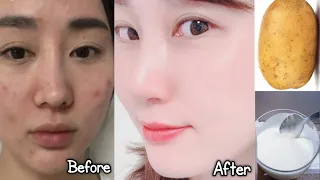 Japanese Secret to Whitening 10 Degrées that Eliminates Pigmentation Dark Spots,get fresh complexion