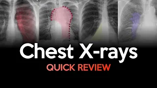 Quick Review of Chest X-Rays