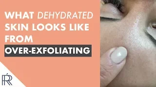 Here Is What Dehydrated Skin Looks Like From Too Much Acid Exfoliation