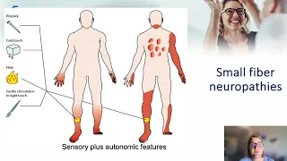 Neurological aspects in Sjögren's - Alessia Alunno ACSP2023