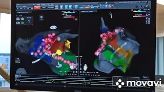РЧА (радиочастотная аблация) после торакоскопической аблации фибрилляции предсердий