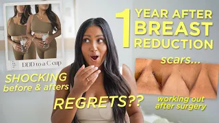 WATCH THIS Before You Consider A Breast Reduction | Scars, REGRETS & Before and Afters 1 Year Later