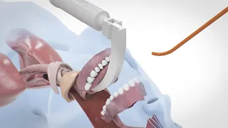 i-Bougie Intubationshilfe