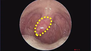 Traumatized Uvula