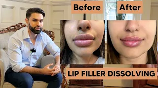 Dissolving Lip Filler | Amazing Results