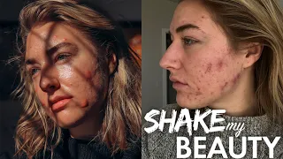 Severe Acne Made Me Feel Unworthy Of Love | SHAKE MY BEAUTY