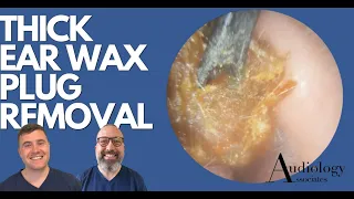 THICK,STICKY EAR WAX PLUG REMOVAL - EP882