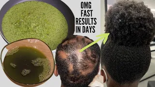 HOW I USE THIS TREATMENTS TO GROW BACK ALOPECIA BALDNESS  SHEDDING & GROW 3 TIMES UNSTOPPABLE FASTER