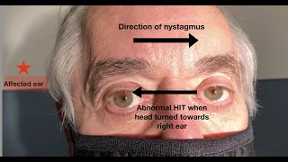 What ear does the nystagmus in vestibular neuritis beat towards?