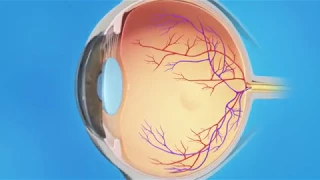 Torn Retina: Photocoagulation