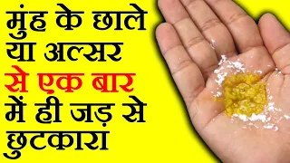 Mouth Ulcers मुँह के छाले एक बार में ही जड़ से ठीक करने के घरेलु उपाय बिना किसी दवाई के