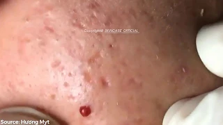 Treatment Of Acne, Blackheads On The Face Easily SS01E14 Part 1