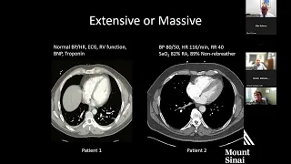 Endovascular Management of Acute Pulmonary Embolism: Dawn of a New Era