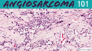 Angiosarcoma 101 (for Pathologists and Dermatologists)