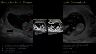 Monochorionic Monoamniotic & Monochorionic Diamniotic Twins Ultrasound Scan | Pregnancy USG #shorts